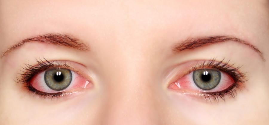 علت و راههای پیشگیری از قرمز شدن چشم چیست ؟ (2 نکته مهم)