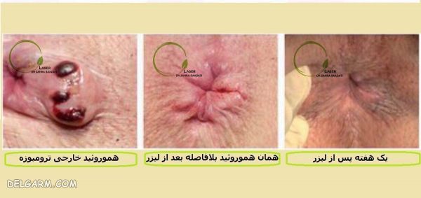 تفاوت اصلی بین بیماری شقاق و بواسیر در چیست ؟ (2 نکته مهم) تفاوت شقاق و بواسیر