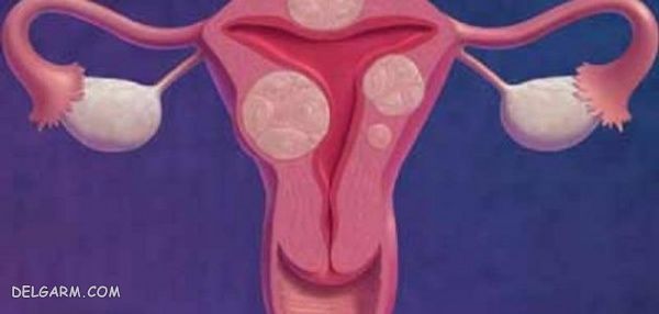 عفونت تخمدانها