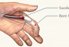 انگشت ماشه ای (trigger finger) چیست و چگونه درمان میشود ؟ (2 نکته مهم)