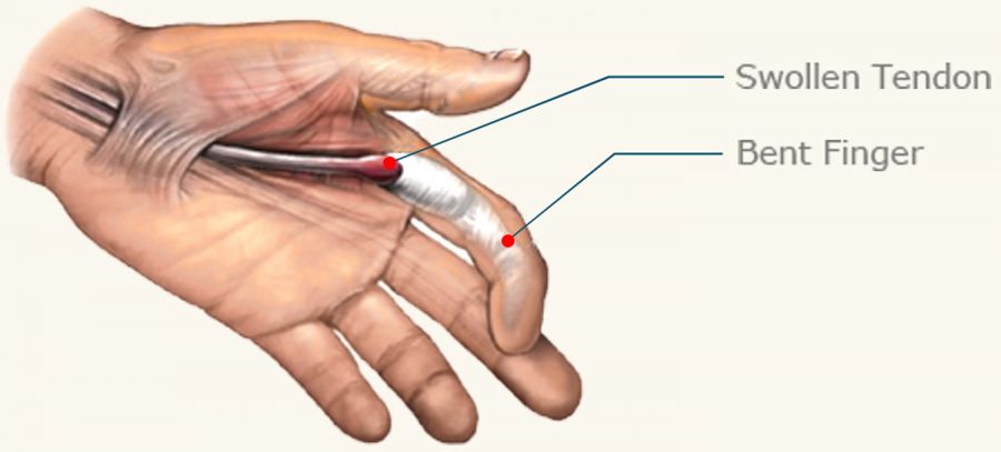 انگشت ماشه ای (trigger finger) چیست و چگونه درمان میشود ؟ (2 نکته مهم) انگشت ماشه ای (trigger finger) چیست و چگونه درمان میشود ؟ (2 نکته مهم)