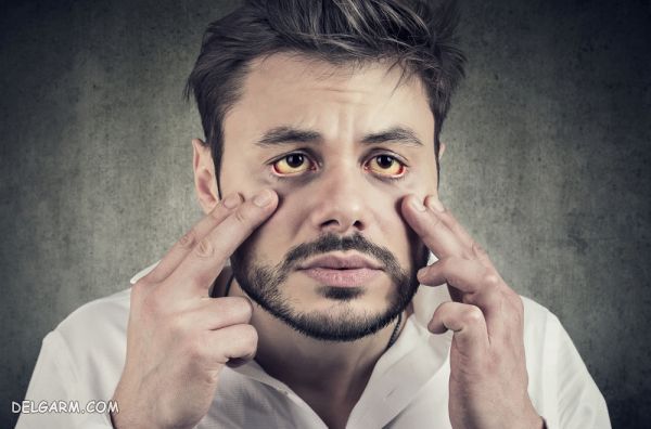 شایع ترین نشانه های کم خونی کدامند ؟ (2 نکته مهم) / علائم کم خونی در زنان / علائم کم خونی در مردان / علائم کم خونی در کودکان/ نشانه های کم خونی / علائم کم خونی