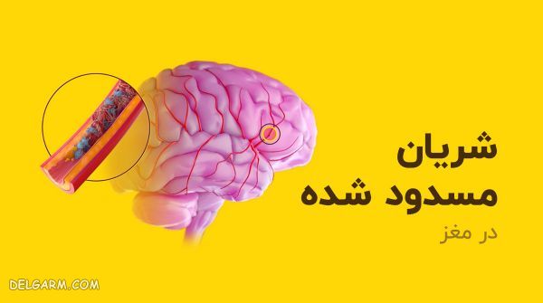 تشخیص سکته مغزی
