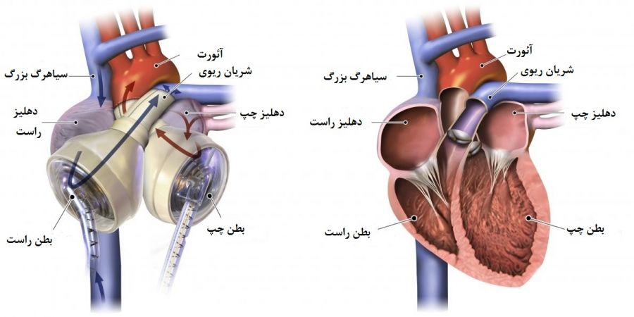 پیوند قلب مصنوعی : قلب مصنوعی چگونه کار میکند ؟ (2 نکته مهم) پیوند قلب مصنوعی : قلب مصنوعی چگونه کار میکند ؟ (2 نکته مهم)