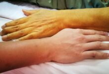 علت و علائم یرقان یا زردی در بزرگسالان چیست و چگونه درمان میشود ؟ (2 نکته مهم)