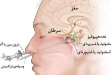 تومور هیپوفیز چیست + درمان تومور هیپوفیز (2 نکته مهم)