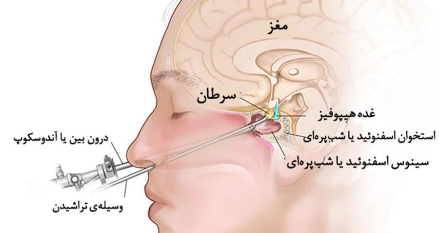 تومور هیپوفیز چیست + درمان تومور هیپوفیز (2 نکته مهم) تومور هیپوفیز چیست + درمان تومور هیپوفیز (2 نکته مهم)