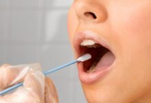 سرطان غدد بزاقی چیست و چگونه تشخیص داده میشود ؟ (2 نکته مهم)