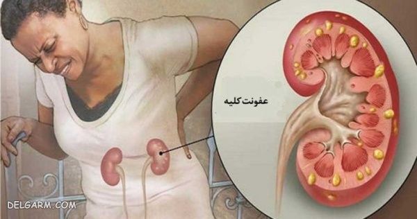 عفونت کلیه