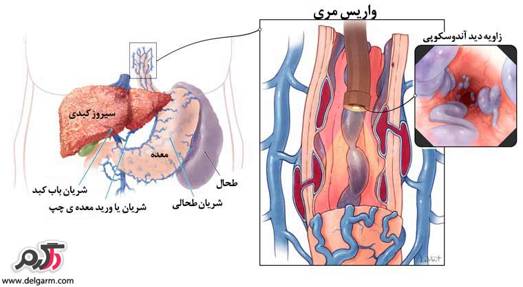 نشانه های ورم معده چیست؟ (2 نکته مهم)