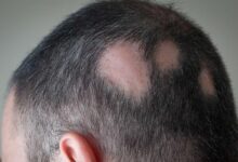 فواید تزریق تریامسینولون در سر برای درمان ریزش مو (2 نکته مهم)