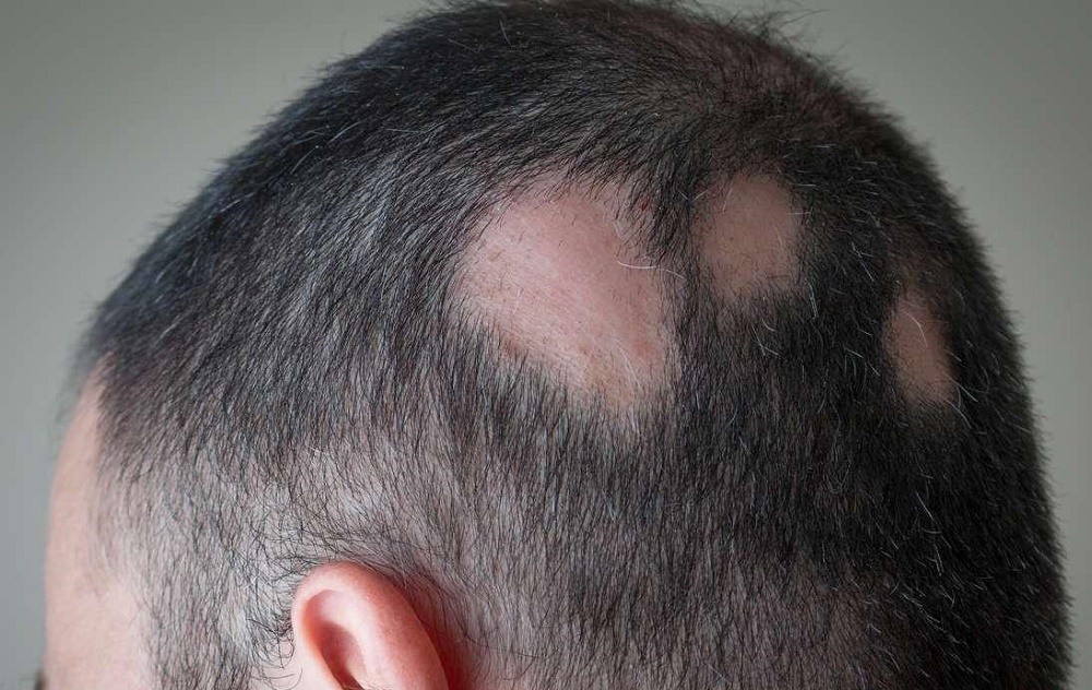 فواید تزریق تریامسینولون در سر برای درمان ریزش مو (2 نکته مهم) فواید تزریق تریامسینولون در سر برای درمان ریزش مو (2 نکته مهم)