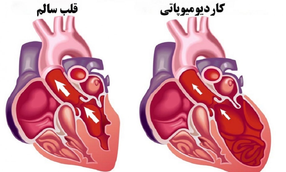 از کاردیومیوپاتی و علائم آن بیشتر بدانید (2 نکته مهم) از کاردیومیوپاتی و علائم آن بیشتر بدانید (2 نکته مهم)
