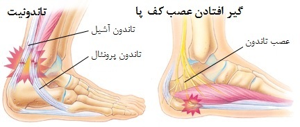 التهاب تاندون آشیل