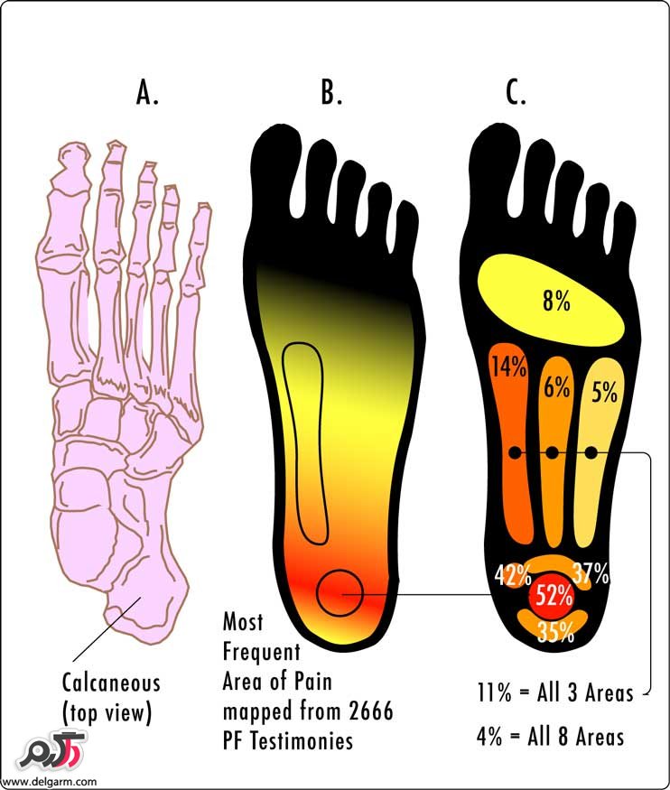 فاسئیت پلانتار Plantar fasciitis چیست