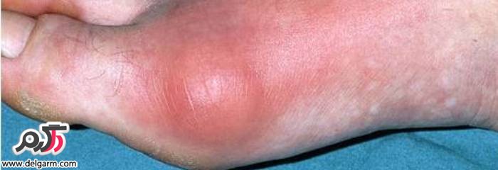 عوارض خطرناک بیماری نقرس (2 نکته مهم)