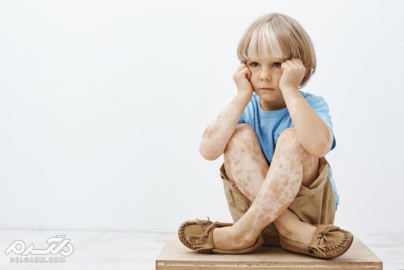 Vitiligo پیسی چیست