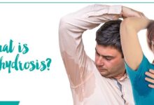 بیماری تعریق بیش از حد یا هایپرهیدروزیس (2 نکته مهم)