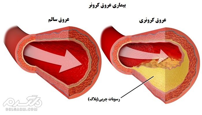 گرفتگی عروق کرونر