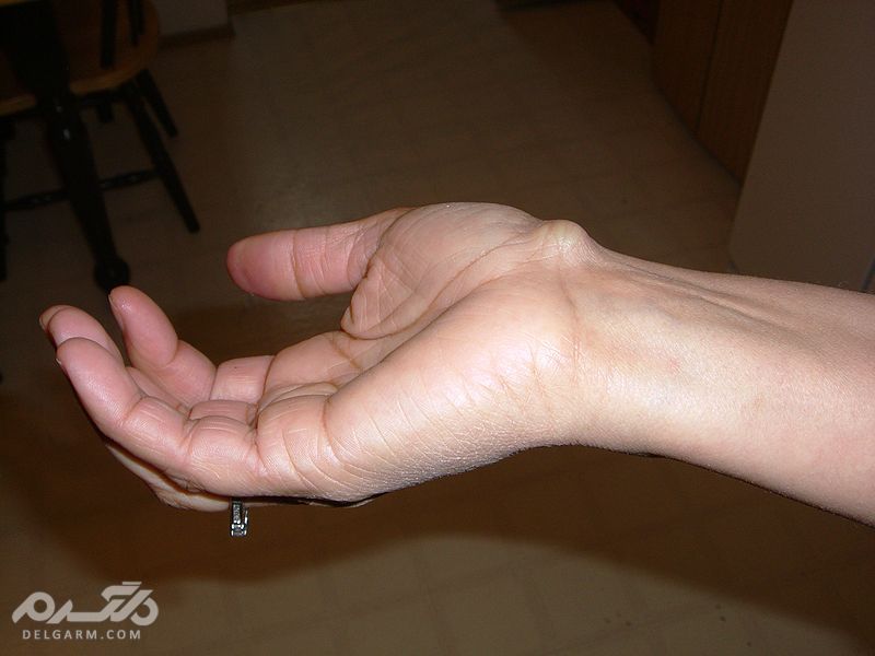 کیست گانگلیون