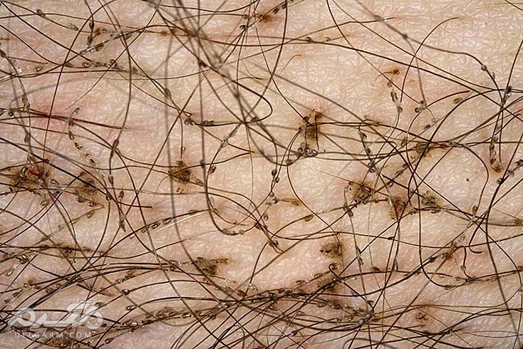 علائم و روش های درمانی بیماری شپش عانه + راه های پیشگیری (2 نکته مهم) شپش پوستی