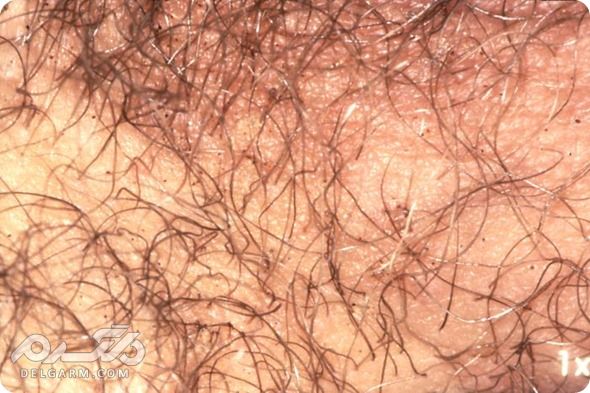 علائم و روش های درمانی بیماری شپش عانه + راه های پیشگیری (2 نکته مهم) شپش پوست