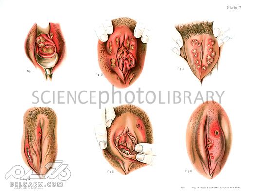 شانکروئید چگونه بوجود میاید؟ معرفی علائم و روش درمان شانکروئی (2 نکته مهم) شانکروئید در زنان