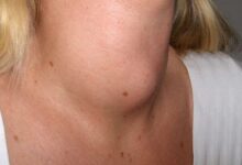 میگزدم ( myxedema ) چیست و چگونه درمان می شود؟ (2 نکته مهم)