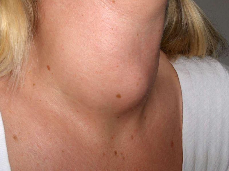 میگزدم ( myxedema ) چیست و چگونه درمان می شود؟ (2 نکته مهم)