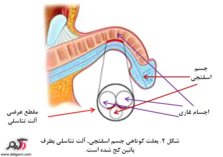 انواع خمیدگی و کجی آلت تناسلی