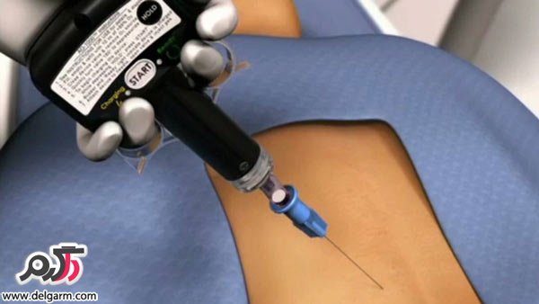 مداخلات کم تهاجمی ستون فقرات با استفاده از عمل (RF)