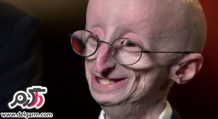 علت سندرم موبیس ‏( mobius syndrome ) (2 نکته مهم)