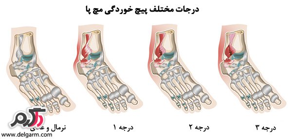 درمان پیچ خوردگی( کشیده شدن رباط) مچ پا  (2 نکته مهم)