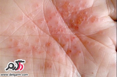 علائم ابتلا به سیفلیس