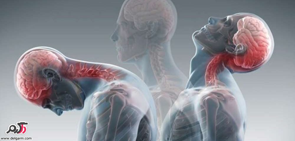 کشیدگی و رگ به رگ شدن گردن از علل مهم گردن درد است