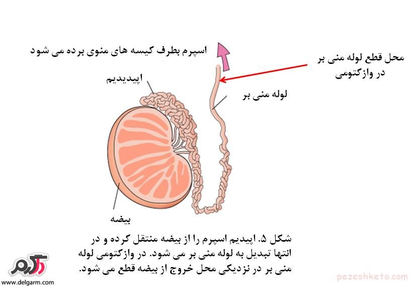 وازکتومی چیست؟ و چه عوارضی دارد؟