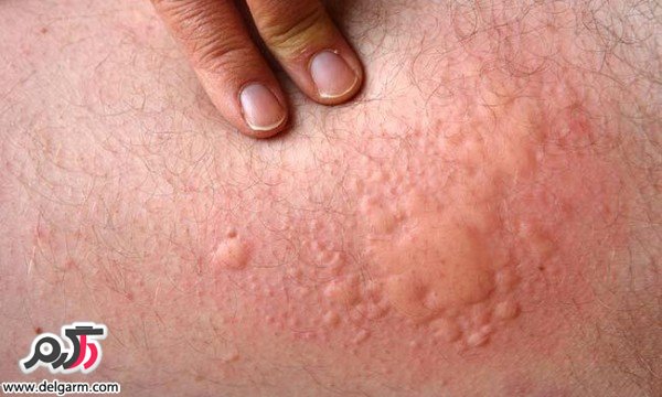 کهیر سرد چیست؟چرا در هوای سرد کهیر میزنید؟! (2 نکته مهم) کهیر سرد چیست؟چرا در هوای سرد کهیر میزنید؟! (2 نکته مهم)