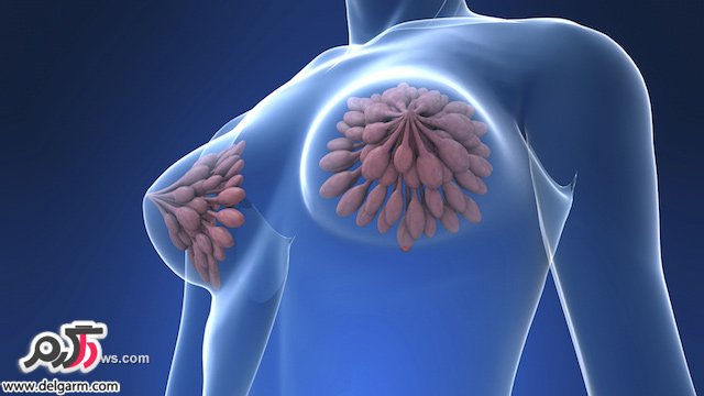 علت سرطان سینه و درمان سرطان پستان(Breast Cancer) (2 نکته مهم) علت سرطان سینه و درمان سرطان پستان(Breast Cancer) (2 نکته مهم)