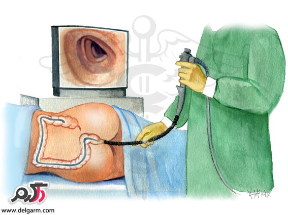 کولونوسکوپی چیست؟چگونه انجام میشود؟(همه چیز راجع به کولونوسکوپی) (2 نکته مهم)