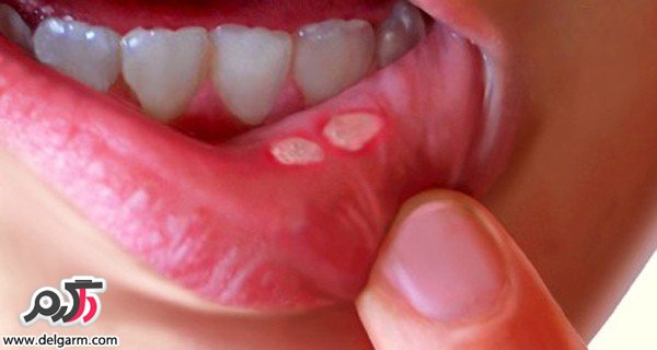 علت ایجاد زخم های دهانی و درمان این عارضه