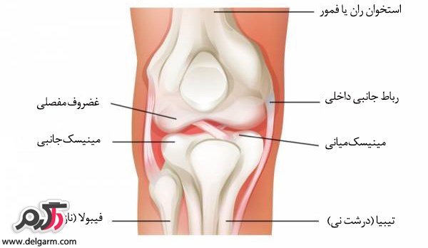 درمان درد مزمن کشکک زانو