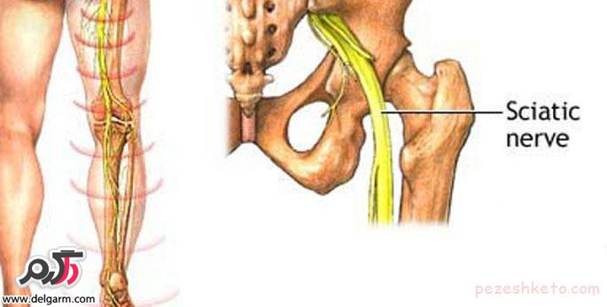 علت ایجاد ساتیک؛پیشگیری و درمان سیاتیک پا و کمر