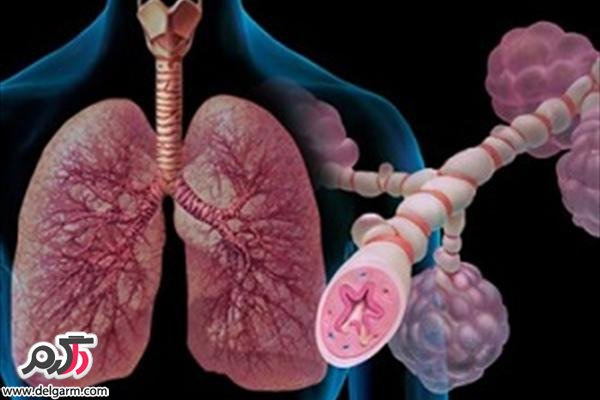 برونشیت: علائم، روش‌های جلوگیری و درمان