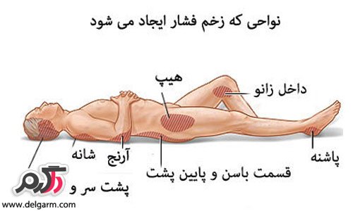 پیشگیری و درمان زخم بستر (2 نکته مهم)