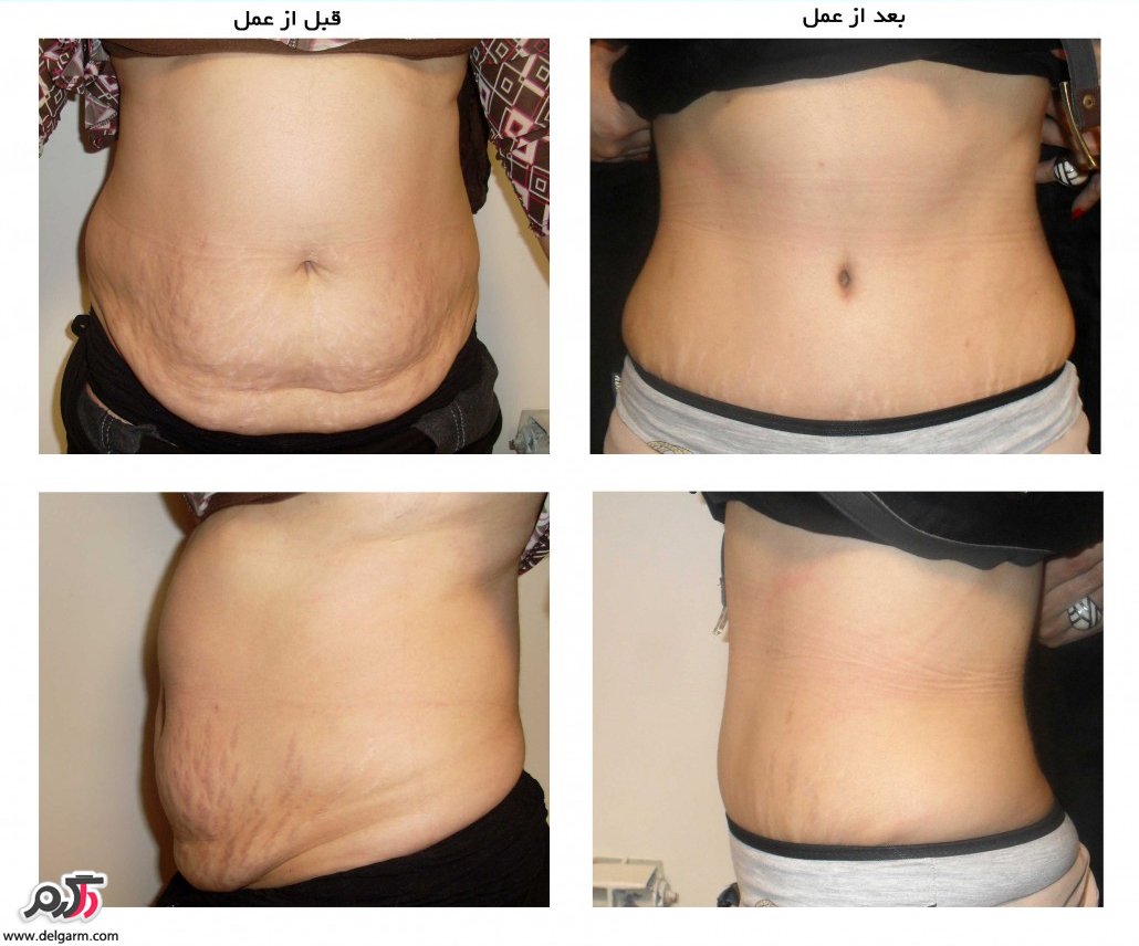 عمل لیپوماتیک و عوارض آن