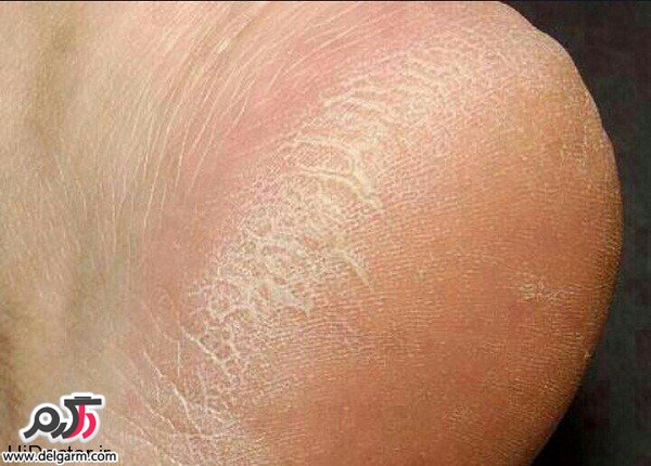 علت ترک پاشنه ی پا چیست ؟ چگونه درمان میشود؟ (2 نکته مهم)