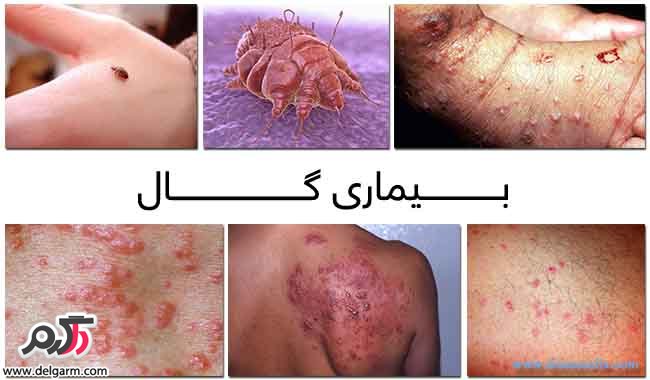 بیماری گال