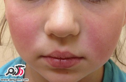 همه ی آنچه که باید درباره ی بیماری لوپوس بدانیم (2 نکته مهم)