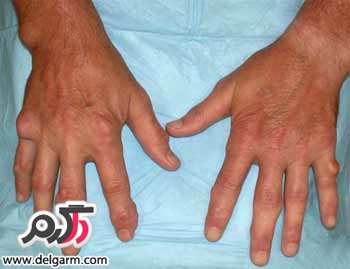 روماتیسم مفصلی(Rheumatoid arthritis) چیست؟ و درمان روماتیسم آن به چه روشی انجام میشود؟ (2 نکته مهم)