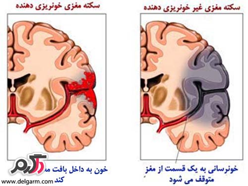 انواع سکته ی مغزی